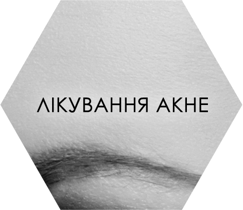 Лікування акне