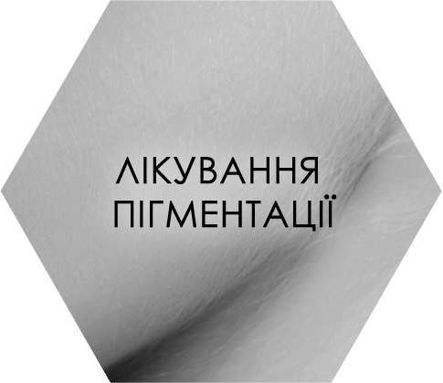 Лікування пігментації